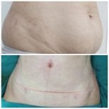 Before and after tummy tuck results at Somchai Clinic – improved abdominal contour