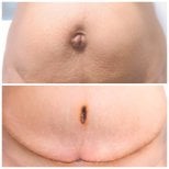 Before and after tummy tuck results at Somchai Clinic – improved abdominal contour