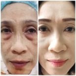 Before and after lower eyelid blepharoplasty results at Somchai Clinic, reduced eye bags