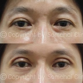 Before and after lower eyelid blepharoplasty results at Somchai Clinic, reduced eye bags