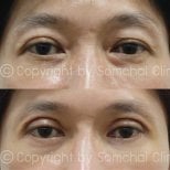 Before and after lower eyelid blepharoplasty results at Somchai Clinic, reduced eye bags