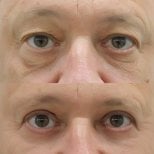 Lower eyelid blepharoplasty before and after results at Somchai Clinic, reduced eye bags