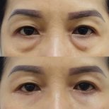 Before and after lower eyelid blepharoplasty results at Somchai Clinic, reduced eye bags