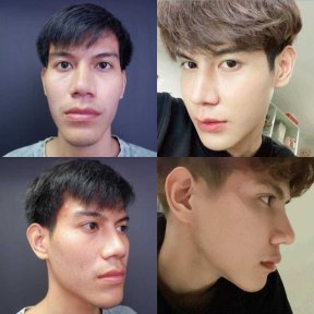 Before and after jaw shaping results at Asia Cosmetic Hospital, improved facial contour