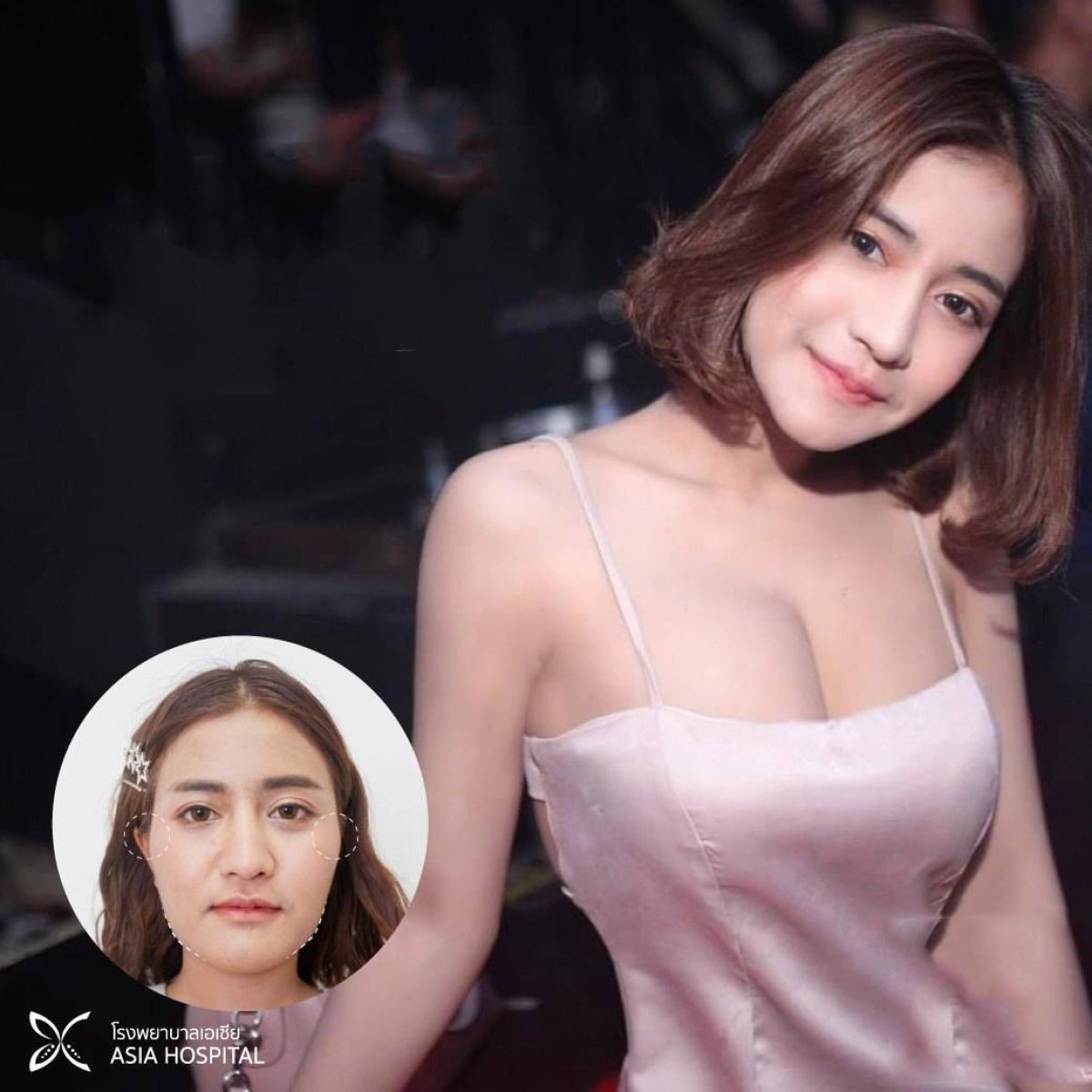Resultados antes y después de perfilado de mandíbula en Asia Cosmetic Hospital, mejora facial