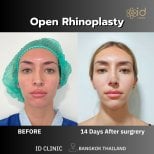 صور قبل وبعد جراحة الأنف (انظر عملية تجميل الأنف) للدكتور 