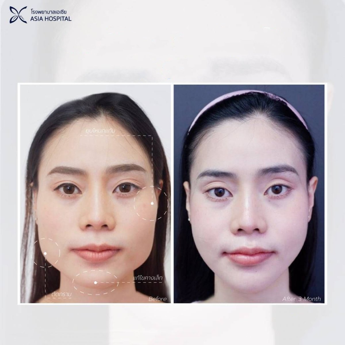 نتائج قبل وبعد تشكيل الفك في Asia Cosmetic Hospital مع تحسين ملامح الوجه
