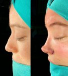 Vorher-nachher-Ergebnis der Revision-Rhinoplastik in der Private Yüzyıl Hospital, Nasenkorrektur