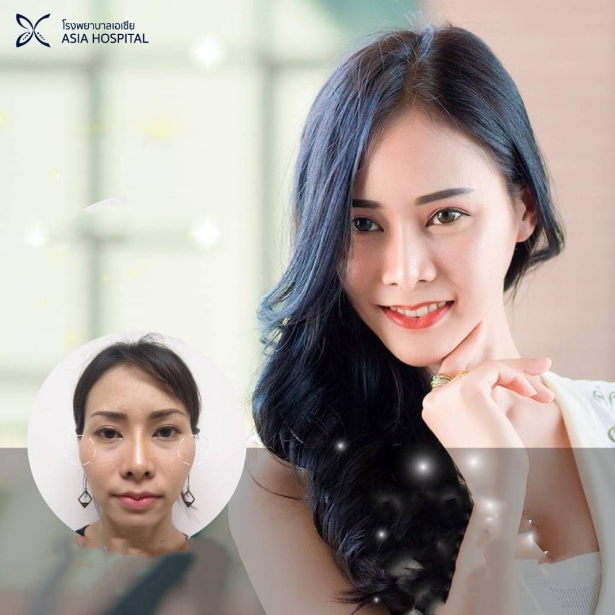Resultados antes y después de remodelación de mandíbula en Asia Cosmetic Hospital, contorno mejorado