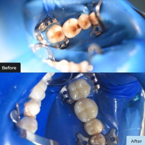Vorher-nachher-Ergebnisse der ästhetischen Kompositfüllung bei Dynasty Stomatology, restaurierte Molaren