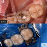 Vorher-nachher-Ergebnis ästhetische Kompositfüllung bei Dynasty Stomatology, Zahnsanierung