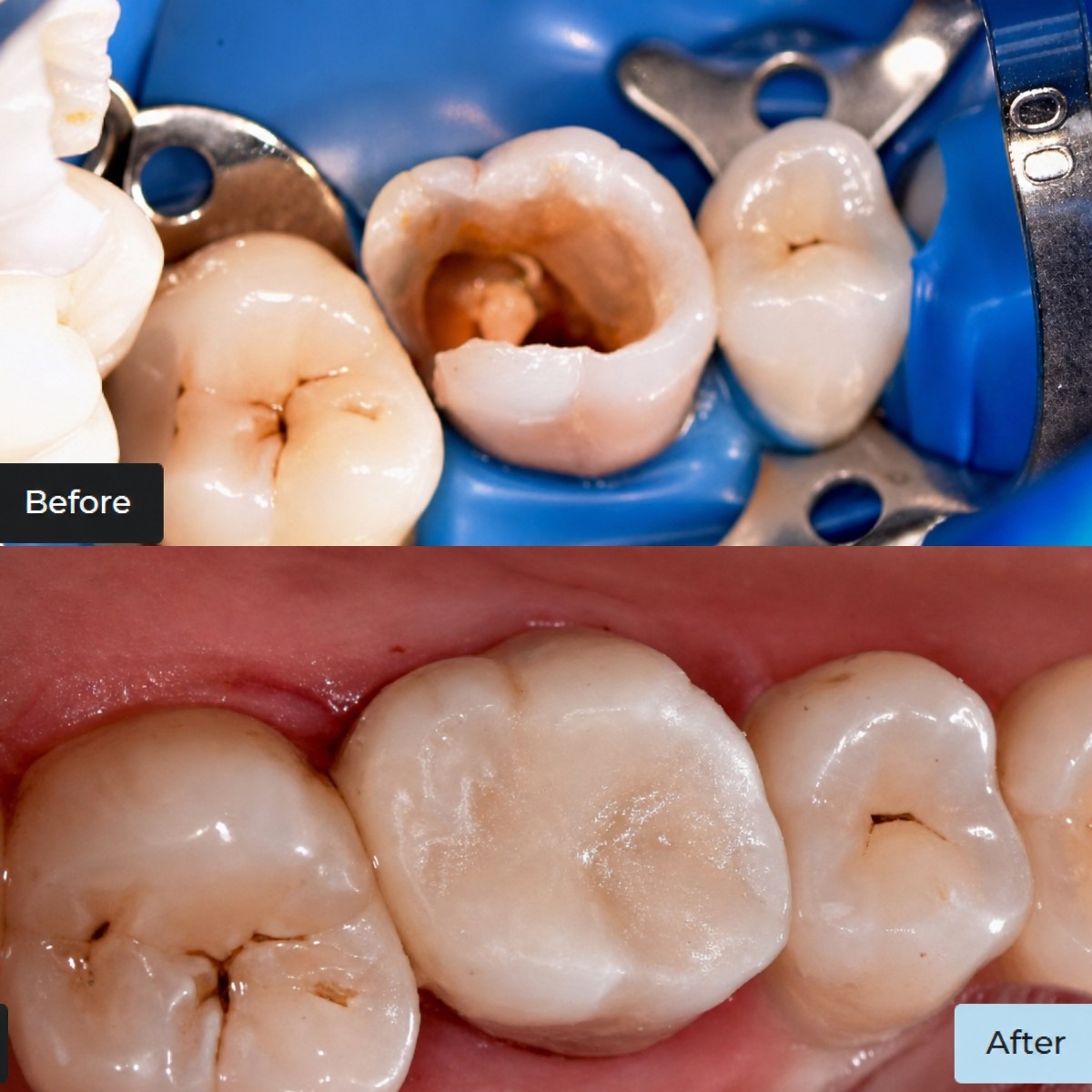 نتائج قبل وبعد حشو الكمبوزيت في Dynasty Stomatology، استعادة مظهر الضرس