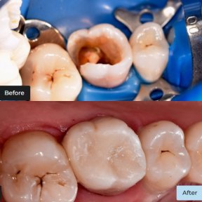 Vorher-nachher-Ergebnis Kompositfüllung bei Dynasty Stomatology, restaurierter Backenzahn