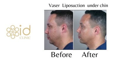 Antes y después de liposucción Vaser bajo la barbilla en ID Clinic Bangkok, contorno visible
