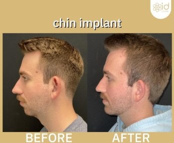 Resultados antes y después de implante de mentón en ID Clinic Bangkok, perfil mejorado