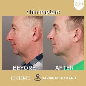 Resultados antes y después de implante de mentón en ID Clinic Bangkok, perfil mejorado