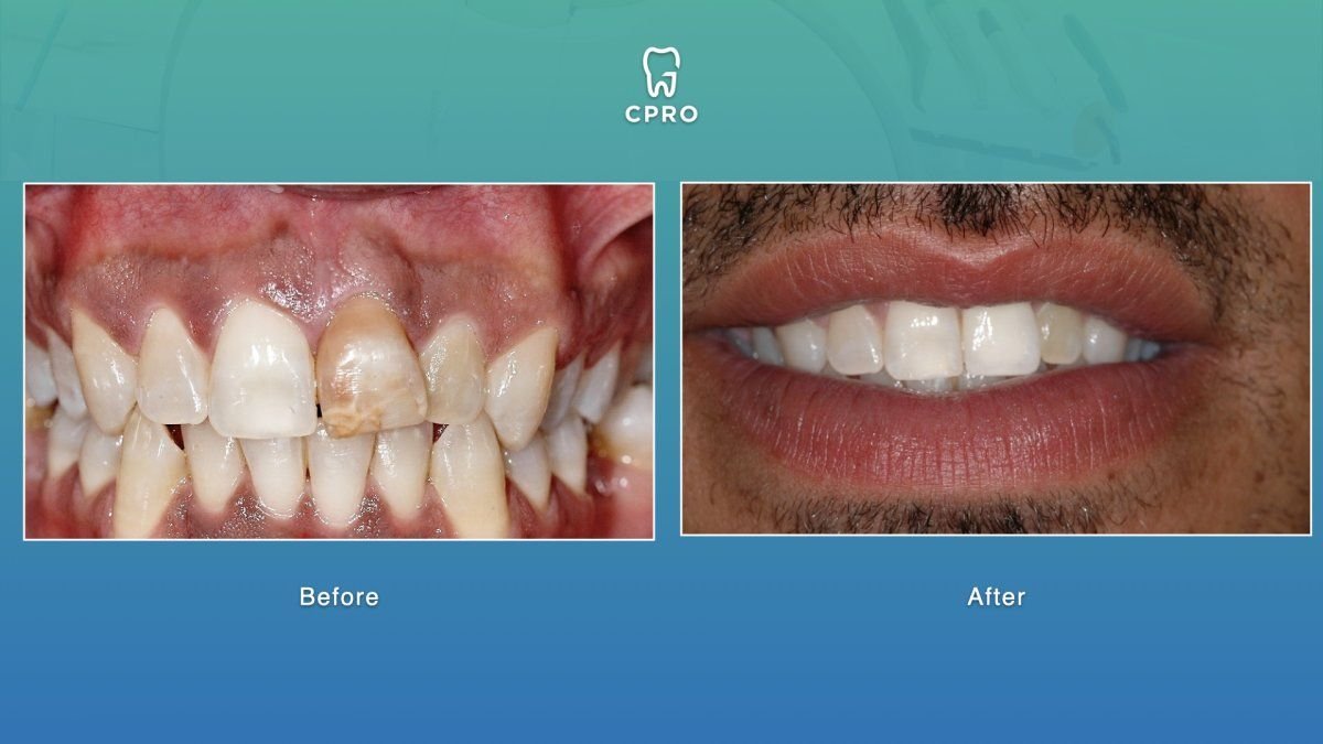 نتائج قبل وبعد عدسات الأسنان الخزفية في CPRO Dental Clinic، تحسين جمالية الابتسامة
