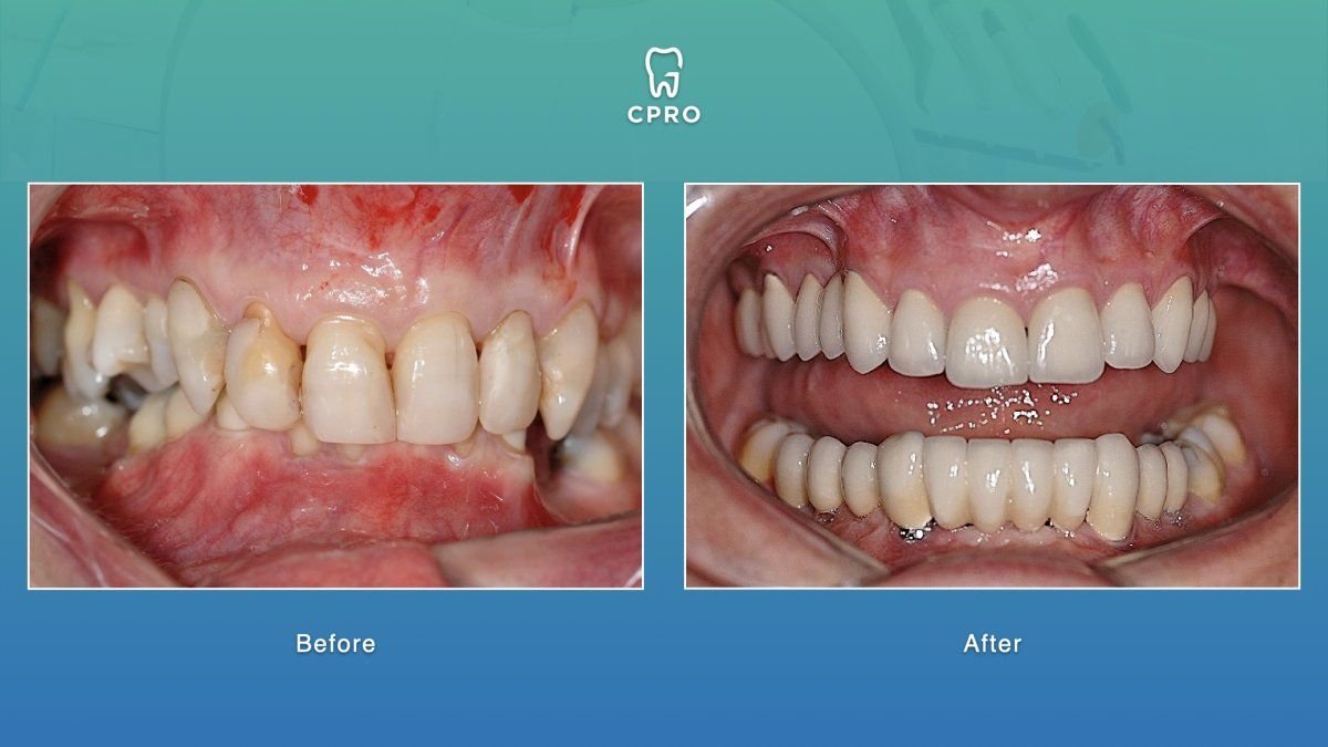 Resultados antes y después de carillas de porcelana en CPRO Dental Clinic, sonrisa mejorada