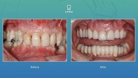 Фото до и после установки керамического винира, доктор 