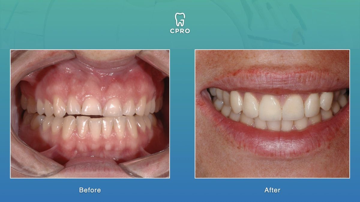 نتائج قبل وبعد عدسات الأسنان الخزفية في CPRO Dental Clinic – تحسين مظهر الابتسامة