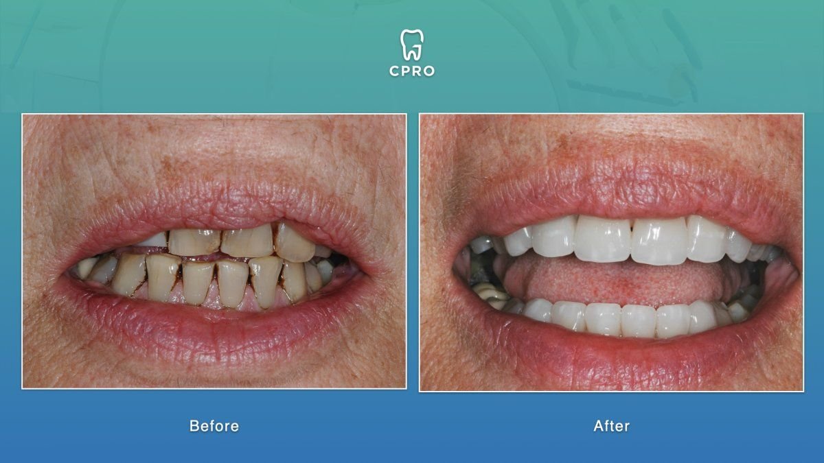 نتائج قبل وبعد قشور البورسلين في CPRO Dental Clinic، تحول ملحوظ في الابتسامة