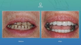 Фото до и после установки керамического винира, доктор 