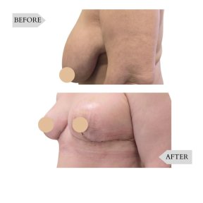 Vorher-nachher-Ergebnisse Bruststraffung bei InSense Clinic (SV Plastic Surgery Clinic), verbesserte Form