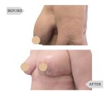 Vorher-nachher-Ergebnisse Bruststraffung bei InSense Clinic (SV Plastic Surgery Clinic), verbesserte Form