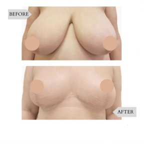 Результаты до и после подтяжки груди в InSense Clinic (SV Plastic Surgery Clinic), улучшенный контур