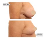 Результаты до и после подтяжки груди в InSense Clinic (SV Plastic Surgery Clinic), улучшенный контур