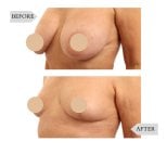 Fotos de antes e depois de Lifting mamário pelo Dr. 