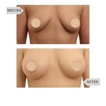 Fotos de antes e depois de Lifting mamário pelo Dr. 
