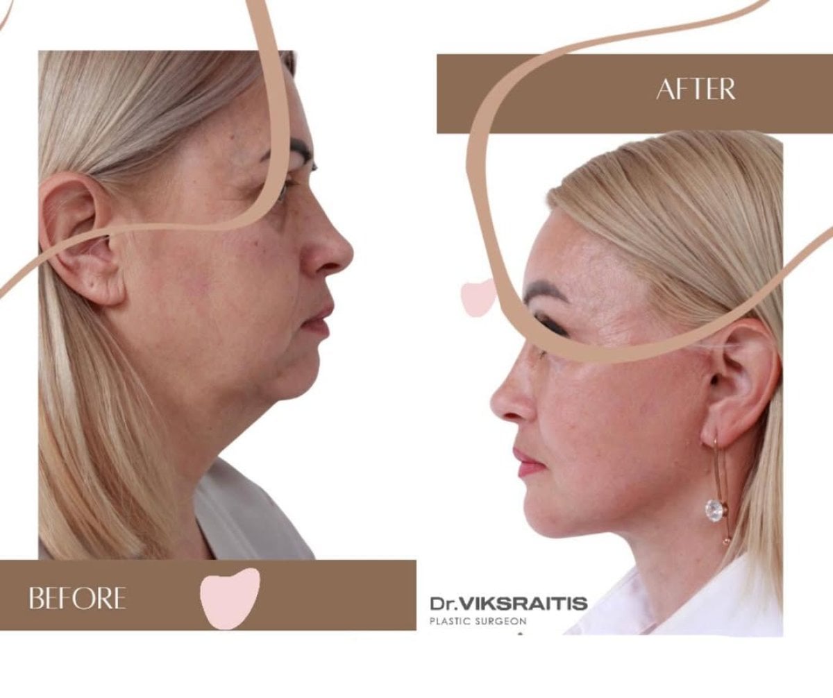 Resultados de lifting facial antes y después en InSense Clinic (SV Plastic Surgery Clinic), rejuvenecimiento