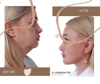 Facelift Vorher-Nachher-Ergebnisse bei InSense Clinic (SV Plastic Surgery Clinic), Gesichtsverjüngung