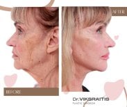 Before and after Facelift photos by Dr. 