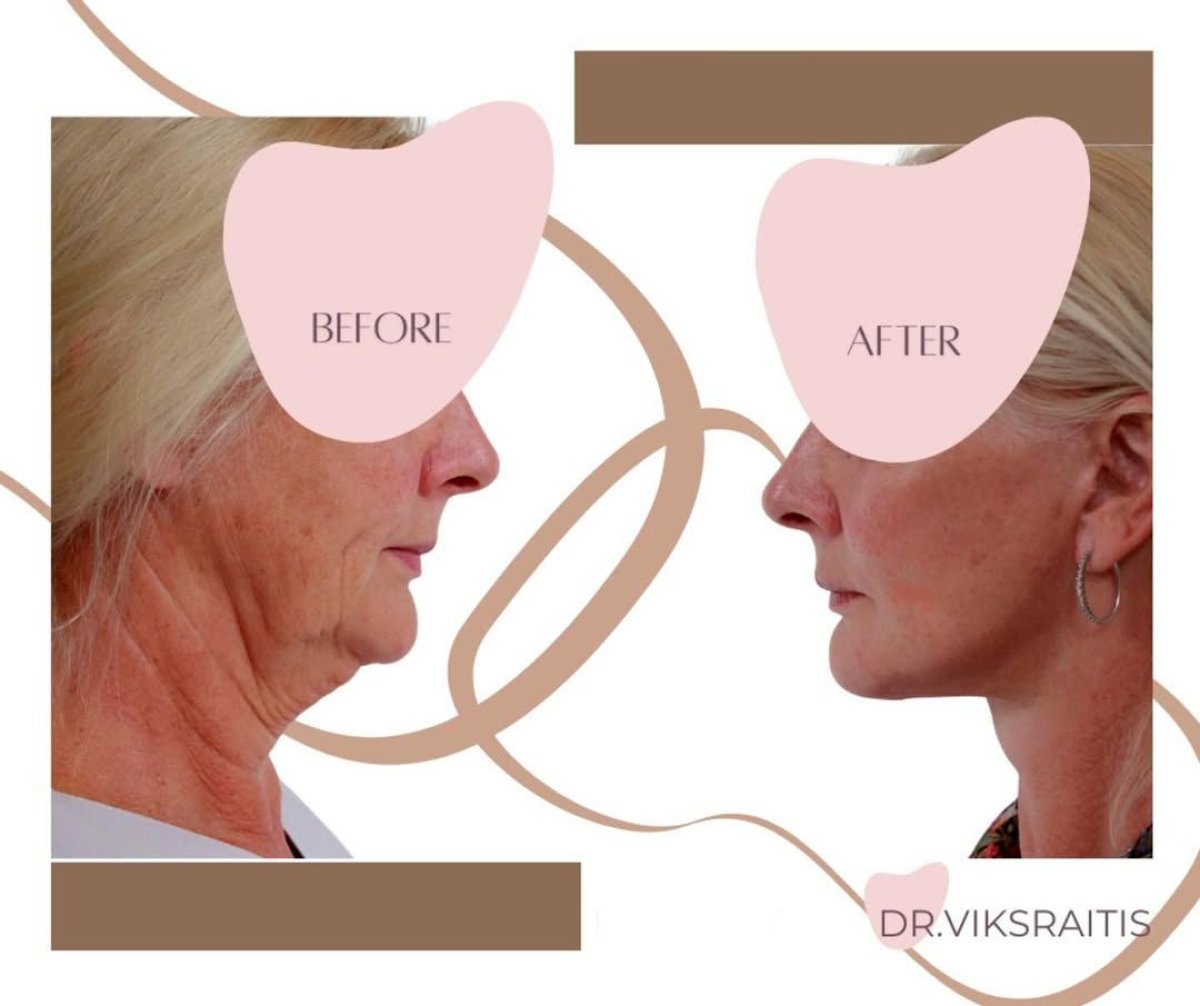 Resultados de lifting facial antes y después en InSense Clinic (SV Plastic Surgery Clinic), cuello más firme