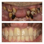 Vorher-nachher-Ergebnisse All-on-4 Zahnimplantate bei Nifa Dent International