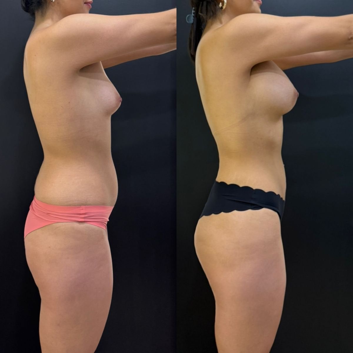 نتائج قبل وبعد شفط الدهون 360 في عيادة Dr. Alexandro Aguilera - Plastic Surgery