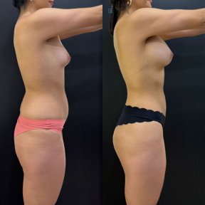 Результаты до и после 360 липосакции в клинике Dr. Alexandro Aguilera - Plastic Surgery