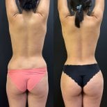 Результаты 360 липосакции до и после в Dr. Alexandro Aguilera - Plastic Surgery, коррекция фигуры