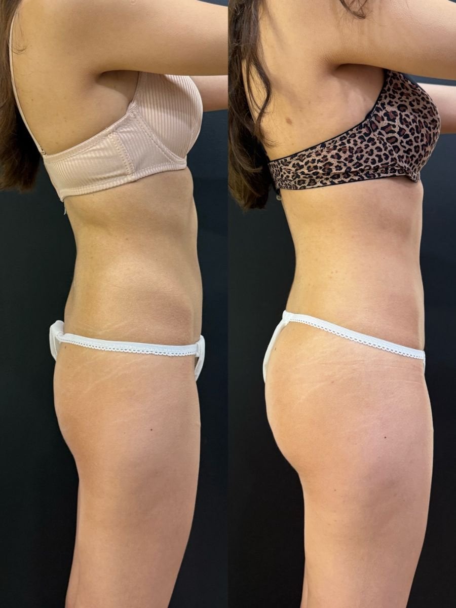 Resultados antes y después de liposucción 360 en Dr. Alexandro Aguilera - Plastic Surgery, contorno corporal