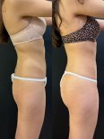 Результаты до и после 360 липосакции в Dr. Alexandro Aguilera - Plastic Surgery, контур тела