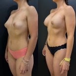 Результати до і після збільшення грудей у клініці Dr. Alexandro Aguilera - Plastic Surgery