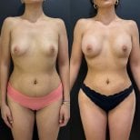 Результаты до и после увеличения груди в клинике Dr. Alexandro Aguilera - Plastic Surgery