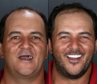 نتيجة قبل وبعد زراعة الأسنان All-on-4 في European Valley Health، استعادة الابتسامة