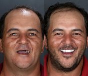 نتيجة قبل وبعد زراعة الأسنان All-on-4 في European Valley Health، استعادة الابتسامة