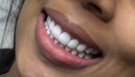 Fotos de antes y después de Implante dental tomadas por el Dr.(la Dra.) 