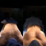 Результаты до и после подтяжки груди в Dr. Alexandro Aguilera - Plastic Surgery, улучшенный контур