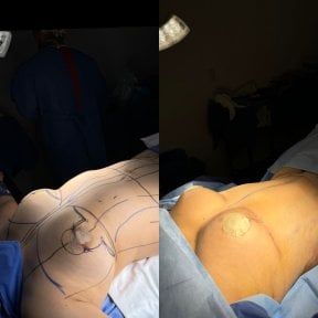 Результаты до и после подтяжки груди в клинике Dr. Alexandro Aguilera - Plastic Surgery