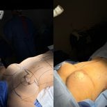 Результаты до и после подтяжки груди в клинике Dr. Alexandro Aguilera - Plastic Surgery